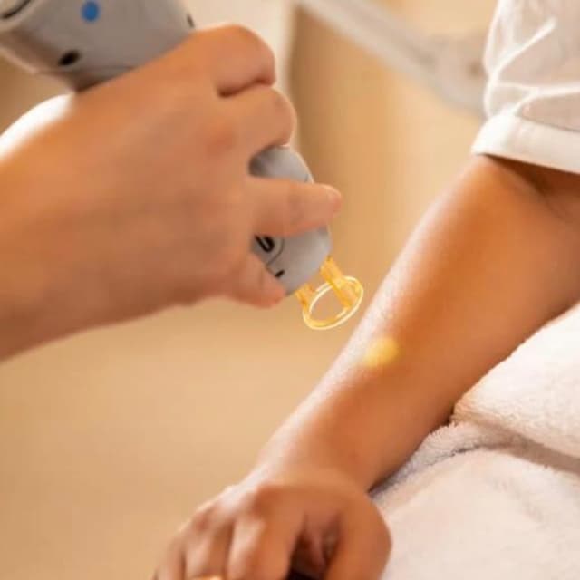 full arms- 6 sessions + 2 free at SLS Laser Medspa in Ontario, CA