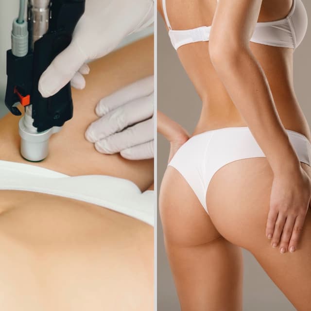 Brazilian Laser-6 Sessions+ 2 Free at SLS Laser Medspa in Ontario, CA