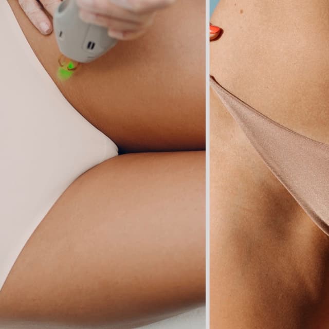 Bikini Laser-6 Sessions +2 Free at SLS Laser Medspa in Ontario, CA